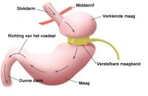 Gratis informatieavond virtuele maagband @ Hypnotherapie | Waalre | Noord-Brabant | Nederland